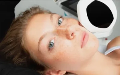 Luz Pulsada Intensa (IPL): Eficacia y precisión en tratamientos estéticos